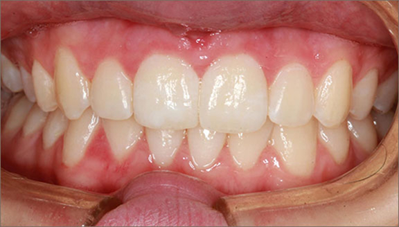 Close up of teeth after treatment