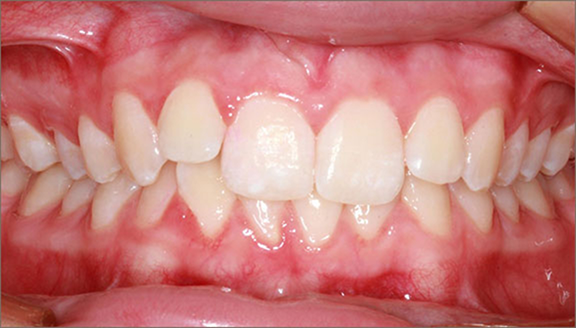 Close up of teeth before treatment