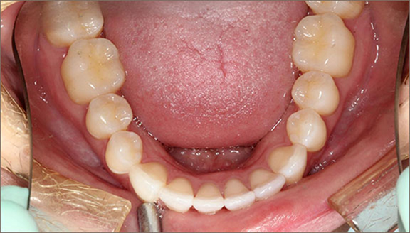 Lower row of teeth after being corrected