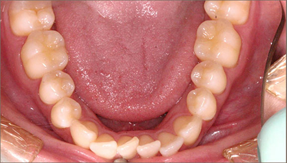 Lower row of teeth with front teeth overlapping