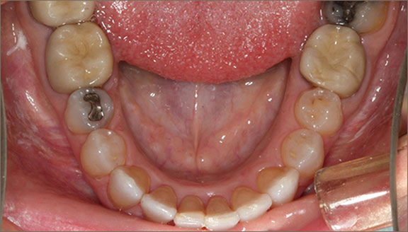 Straightened lower front teeth