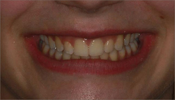 Close up of smile after treatment