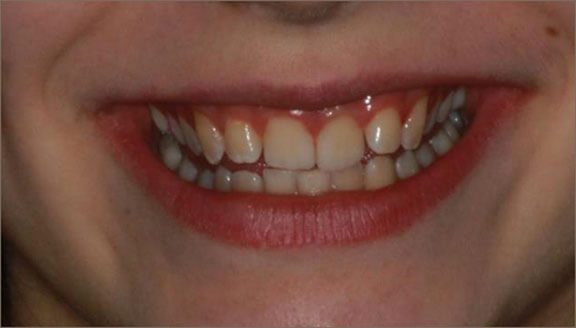 Close up of smile before treatment