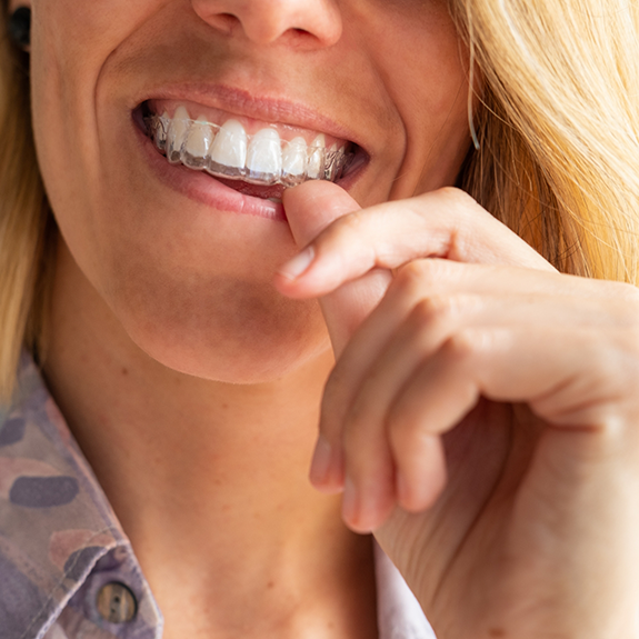 Woman putting in Invisalign clear aligner in Reynoldsburg