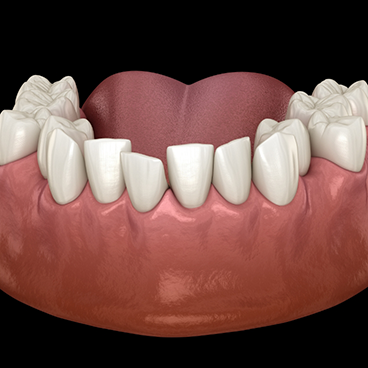 Illustration of crowded teeth