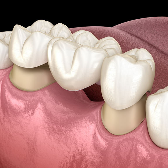 Illustration of dental bridge being attached to teeth