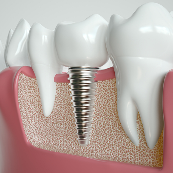 Illustration of dental implant between natural teeth