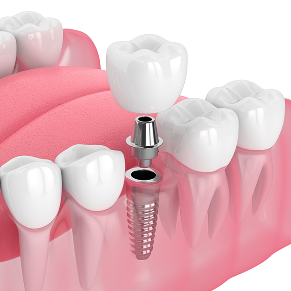 Illustration of abutment and crown being attached to dental implant