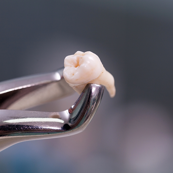 Close up of forceps holding tooth