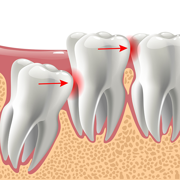 Illustration of impacted wisdom tooth pressing on teeth