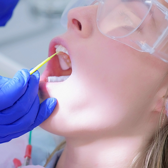 Applying fluoride to the upper teeth