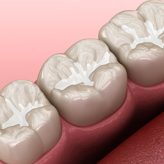 Illustration of teeth with dental sealants