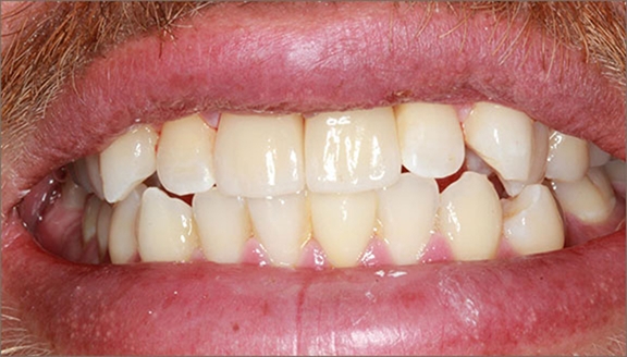 Close up of fully repaired upper teeth