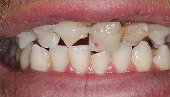 Close up of badly damaged upper teeth