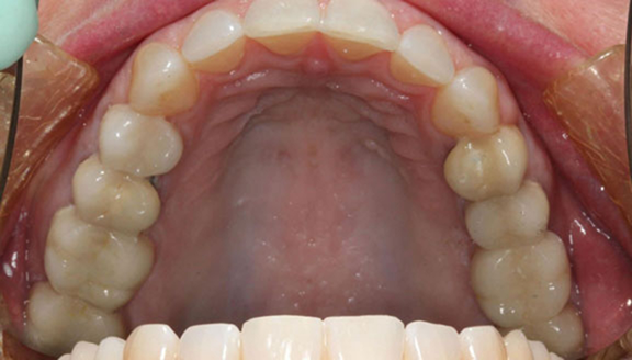 Shot of teeth after rehabilitation