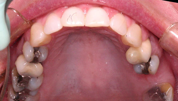 Shot of teeth before rehabilitation