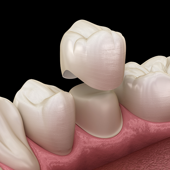 Illustration of dental crown being placed on tooth