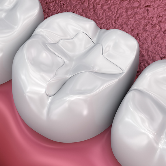 Illustration of teeth with tooth colored fillings