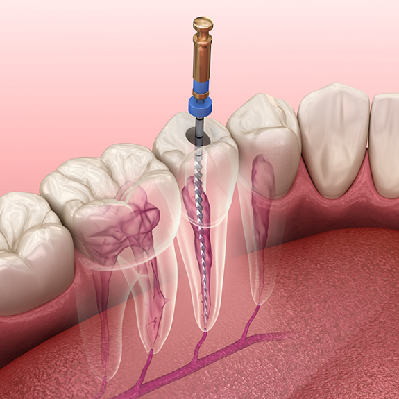 Illustration of root canal treatment in Reynoldsburg