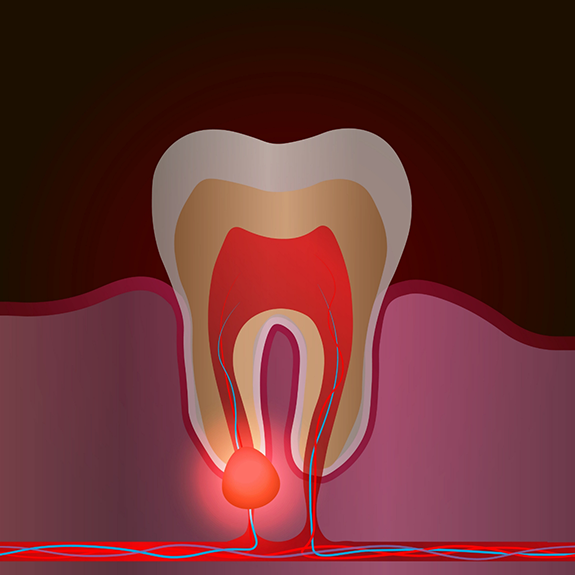 Illustration of an infected tooth