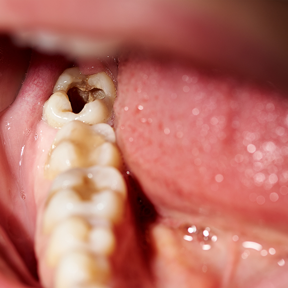 Close up of teeth that have been badly decayed