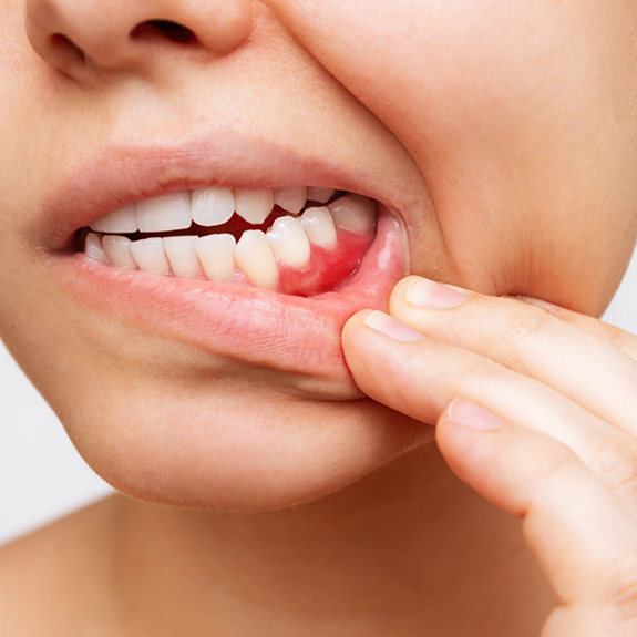 Close up of person pulling down lip to show inflamed gums