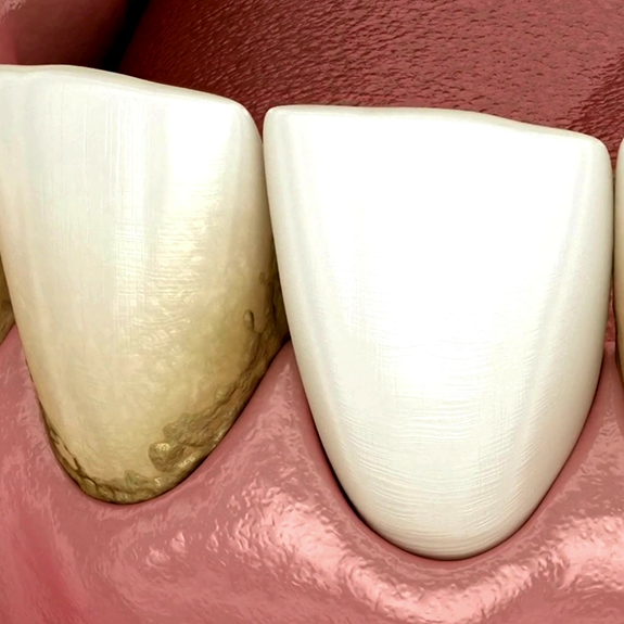 Close up of teeth with plaque