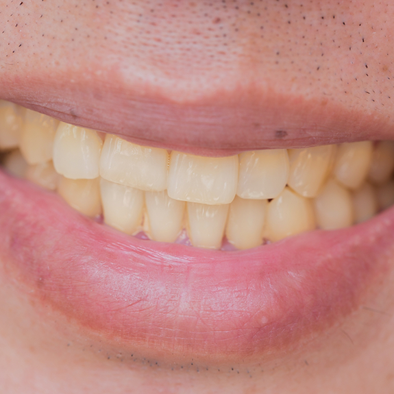 Close up of smile with yellowed teeth