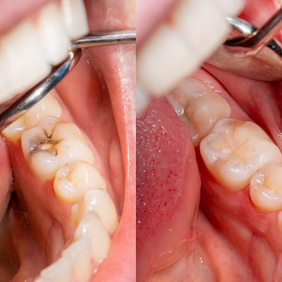 Teeth before and after tooth colored fillings in Reynoldsburg