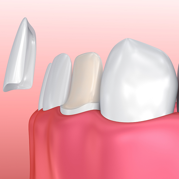 Illustration of veneer in Reynoldsburg being attached to tooth