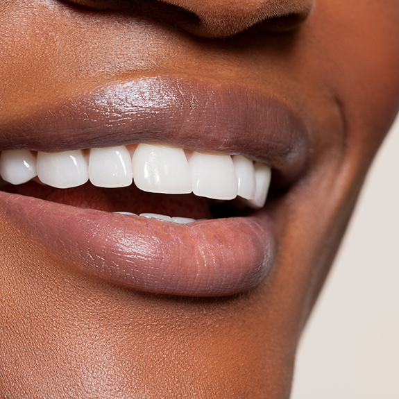 Close up of teeth enhanced by veneers