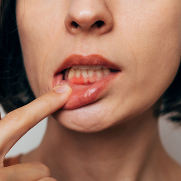 Woman pulling down lip to show gums