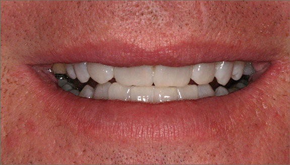 Brighter teeth after whitening