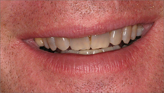 Dull teeth before whitening