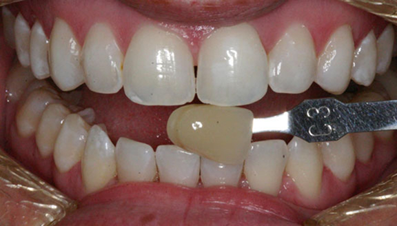 Close up of brightened teeth and shade matching tool