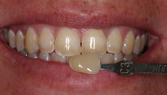 Close up of yellowed teeth and shade matching tool