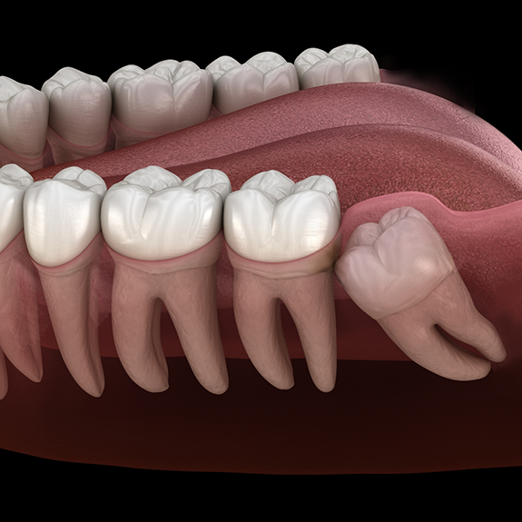 Illustration of impacted wisdom tooth