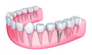 Columbus dentist offers dental implants to qualified candidates. 